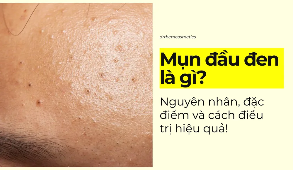 Mụn đầu đen là gì? Nguyên nhân, đặc điểm và cách điều trị hiệu quả