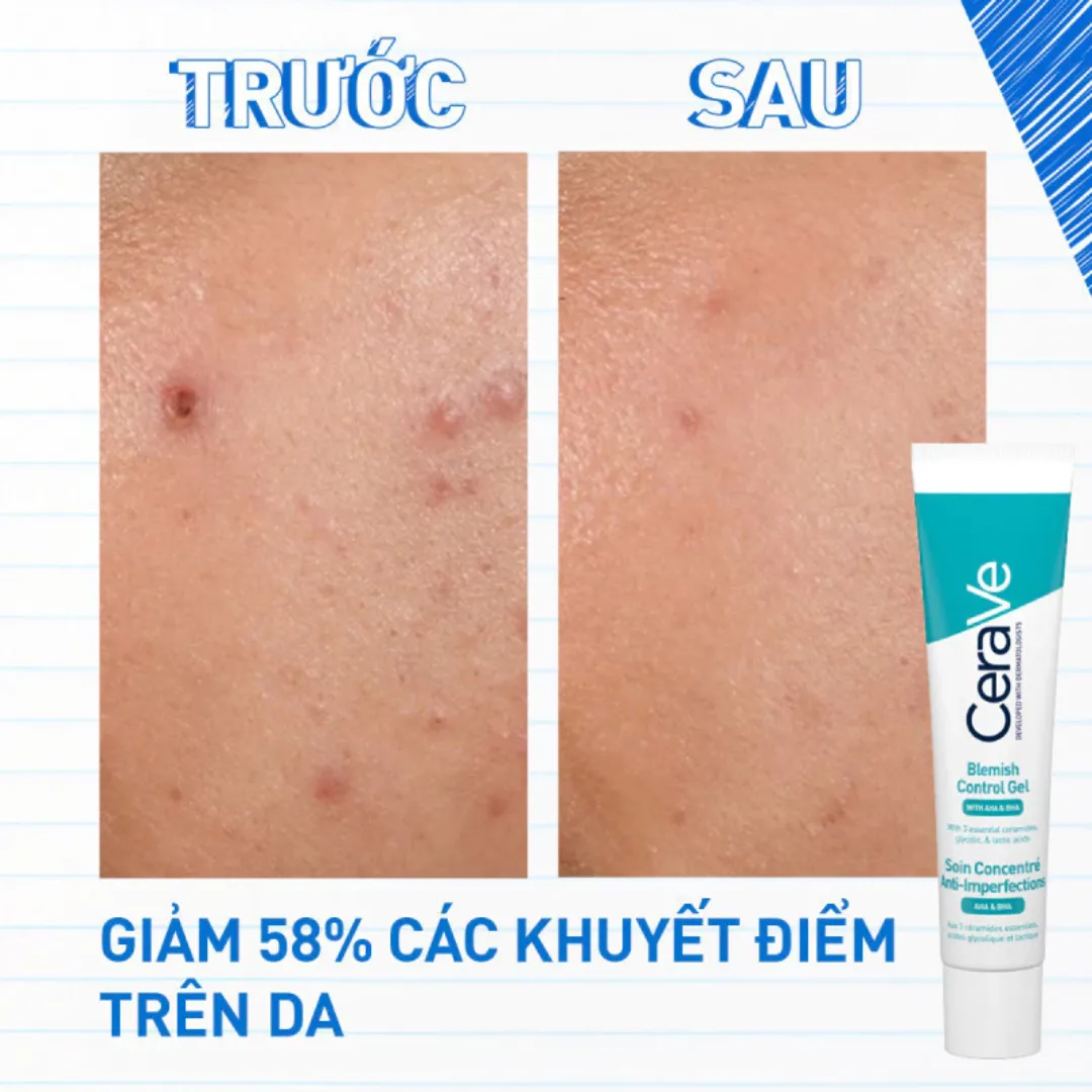 Gel Giảm Mụn CeraVe Blemish Control Gel AHA BHA Hỗ Trợ Mờ Thâm Se Khít Lỗ Chân Lông Cho Da Dầu Mụn 40ml 3