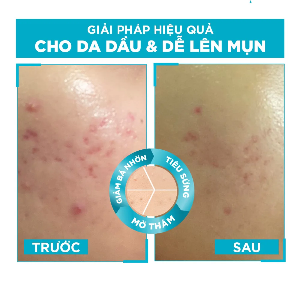 Serum Garnier Bright Anti Acne Booster Serum Hỗ Trợ Giảm Mụn Mờ Thâm Dưỡng Sáng Cho Da Dầu Mụn 30ml 5