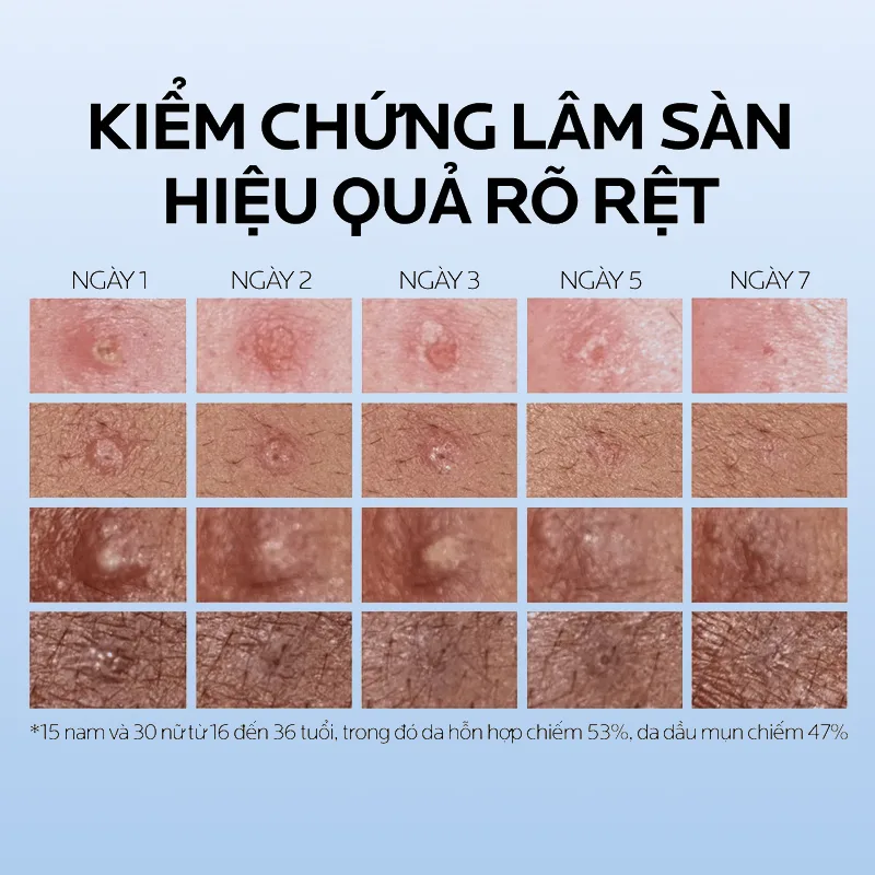 Kem Dưỡng La Roche-Posay Effaclar Duo+ M Hỗ Trợ Giảm Mụn Giảm Thâm Kiềm Dầu Cho Da Dầu Mụn 7.5ml/40ml 6