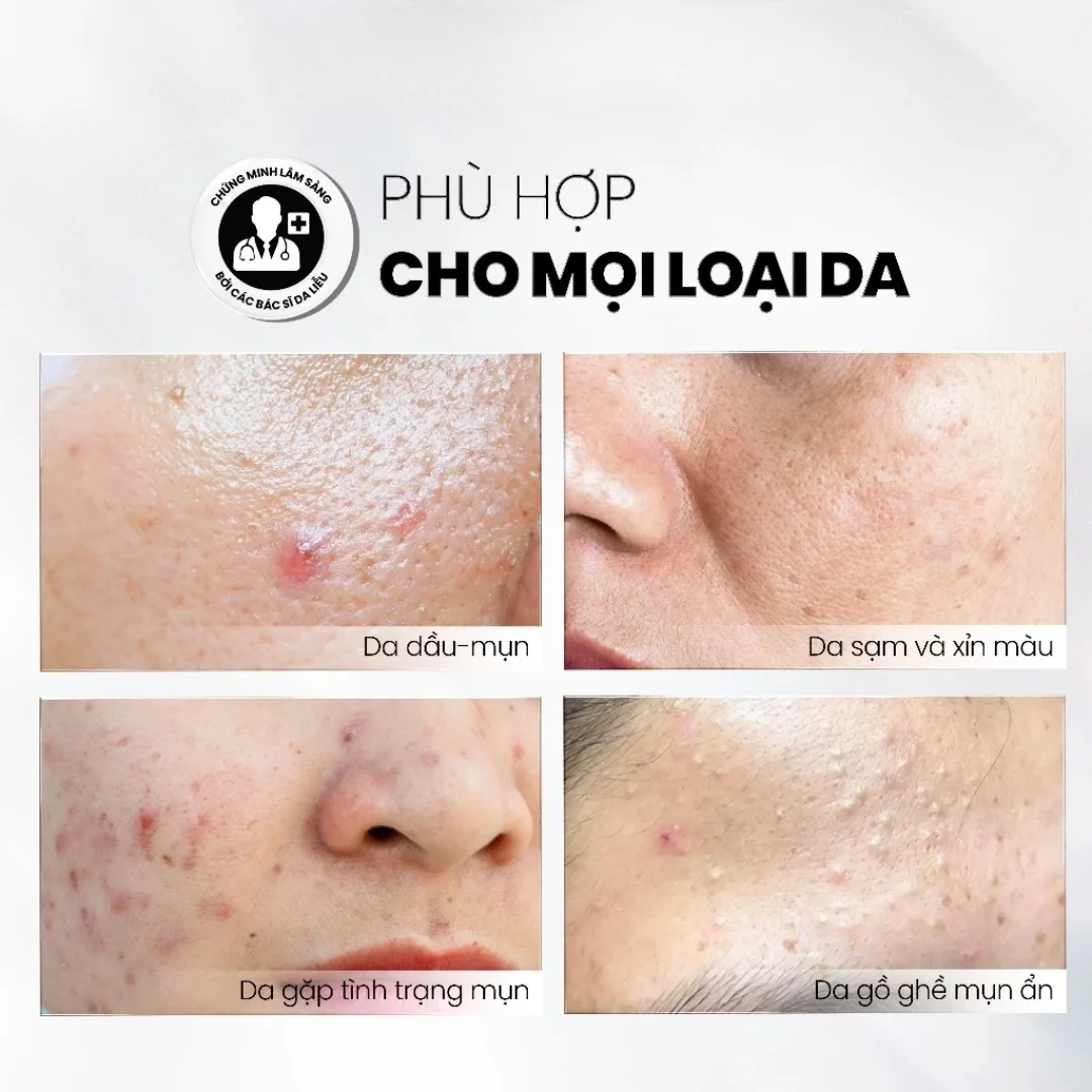 Tinh Chất Tẩy Tế Bào Chết MD CARE AntiAc Exfo Hỗ Trợ Giảm Mụn Kiềm Dầu Làm Dịu Da Cho Da Dầu Mụn 10ml/30ml 6