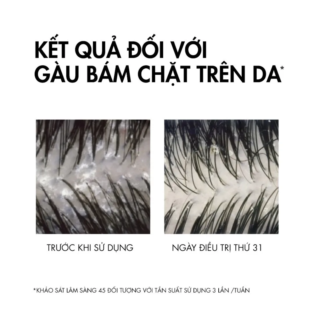 Dầu Gội Vichy Dercos Technique Anti Dandruff Advanced Action Hỗ Trợ Giảm Gàu Cho Da Đầu Dầu 50ml 200ml 4